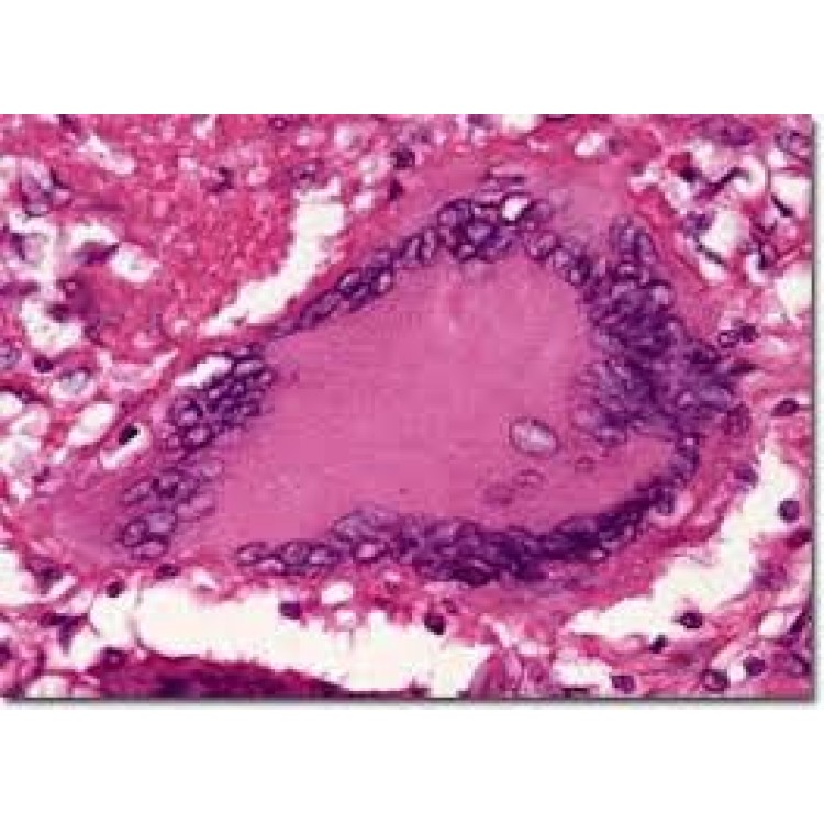 Tuberculinum Tuberculinum
